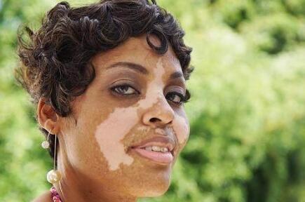 邯郸哪里有看白癜风的老中医,邯郸有个地方看白癜风