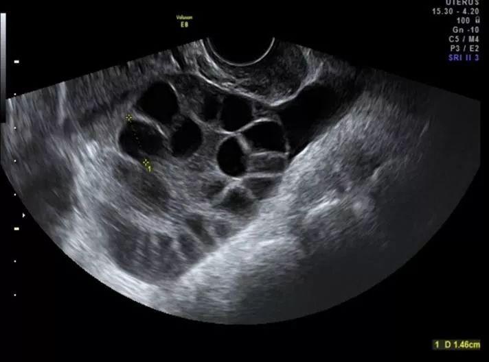 取完卵后喝脉动可以排腹水吗,取完卵以后盆腔积液是腹水吗