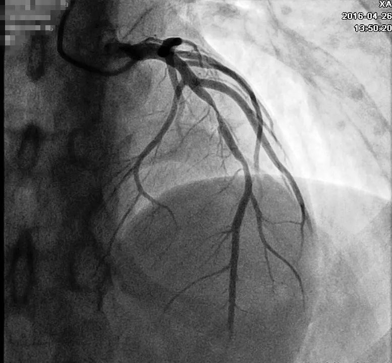 发作性胸痛心电图正常,心电图轻度T波改变图片
