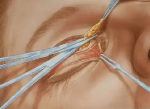 双眼皮是怎么搞的,双眼皮是怎么弄出来的