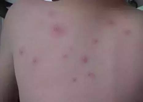 鉴别疱疹性咽峡炎和手足口病,疱疹性咽峡炎转成手足口了怎么办