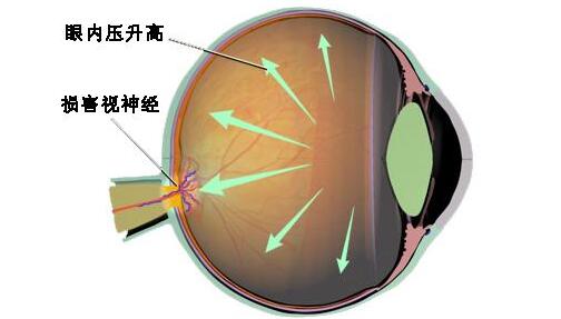 眼压升高用什么办法治,使眼压增高的药