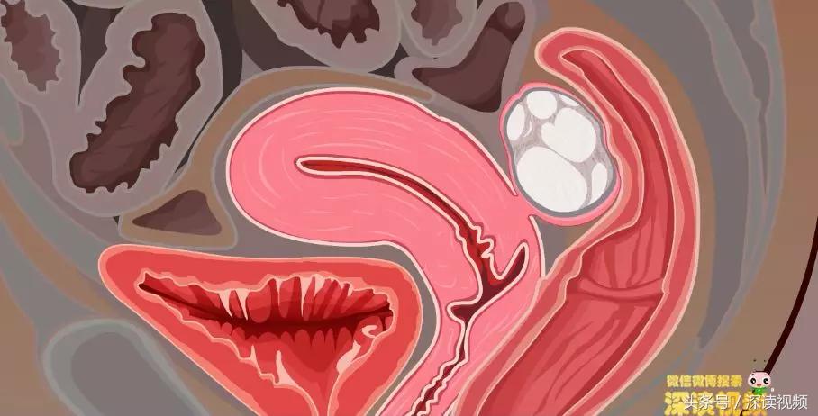 子宫肌瘤在哪个地方影响怀孕,子宫肌瘤剔除怎么还有东西流出来