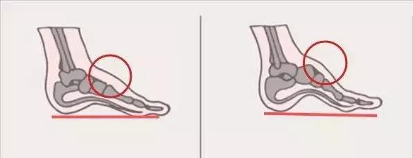 畸形脚型,看脚型分辨你适合穿怎样的鞋子
