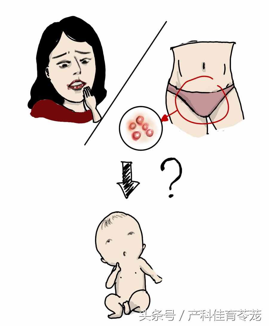孕妈妈患有疱疹会对小孩有影响吗,孕妈妈鼻子长疱疹怎么办