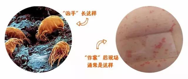 蚊虫咬了小宝宝,蚊虫咬了儿童用什么药