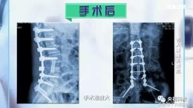 健康之路|82岁高龄腰病患者,这样治疗后身体恢复如初!