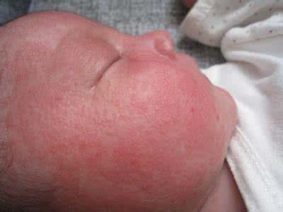 容易长湿疹教你3个方法赶走湿疹,宝宝湿疹快速消除小窍门