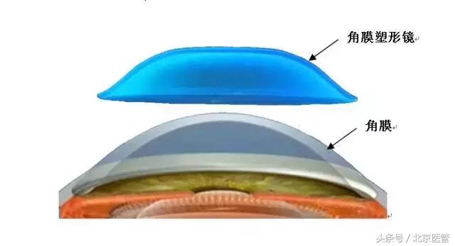 小孩近视去视力矫正中心有用吗,同仁医院看近视眼全过程