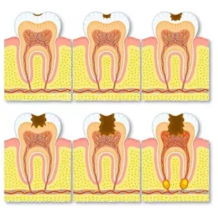 乳牙蛀了不用管,乳牙蛀了没掉下来