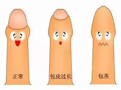 30岁做包皮手术做哪种最合适,30岁的男人适合做包皮手术吗