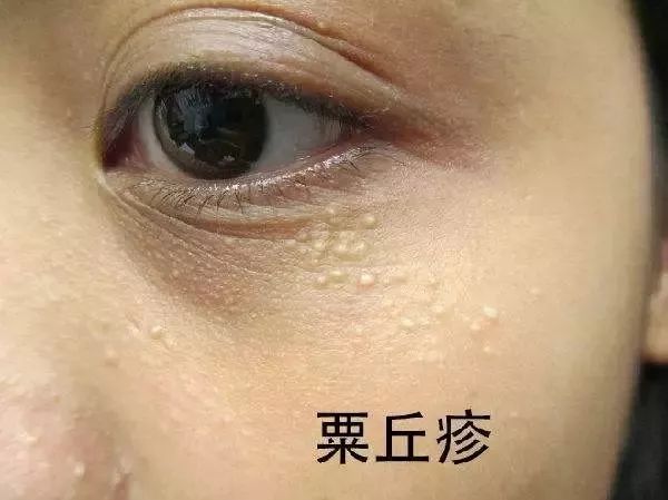 擦眼霜眼角长了脂肪粒,眼睛长脂肪粒和眼霜有关系吗