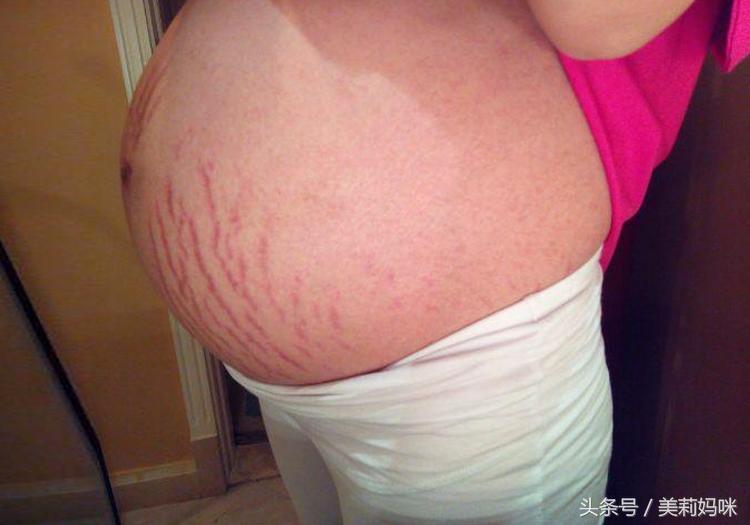 孕期长妊娠纹怎么去除,孕期长的妊娠纹怎么去除