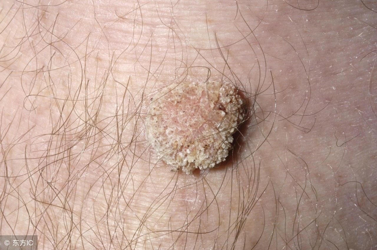 生活小妙招去除寻常疣,怎么预防寻常疣最有效方法