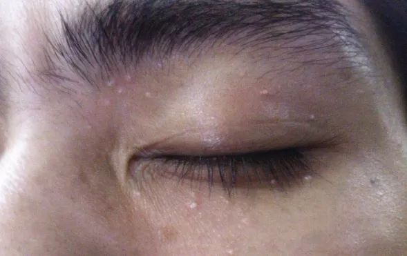 不用针挑手指扎进刺了怎么办,不用针挑就能挑出刺的方法