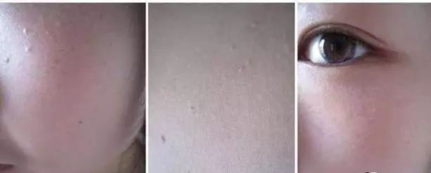 不用针挑手指扎进刺了怎么办,不用针挑就能挑出刺的方法