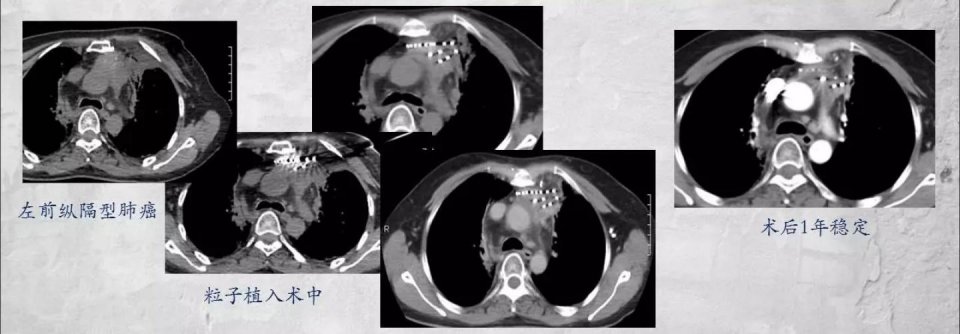 除了靶向免疫还有别的方法吗,除了靶向药还有什么方法治疗