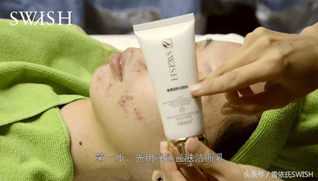 美容院排痘痘的方法,美容店祛痘痘的手法