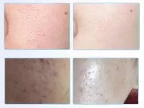 亲试十大祛痘药,亲测各类祛痘印护肤品