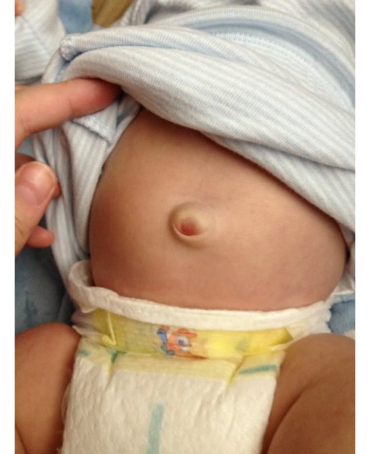 宝宝腹压,为什么宝宝腹压增高就吐奶呢