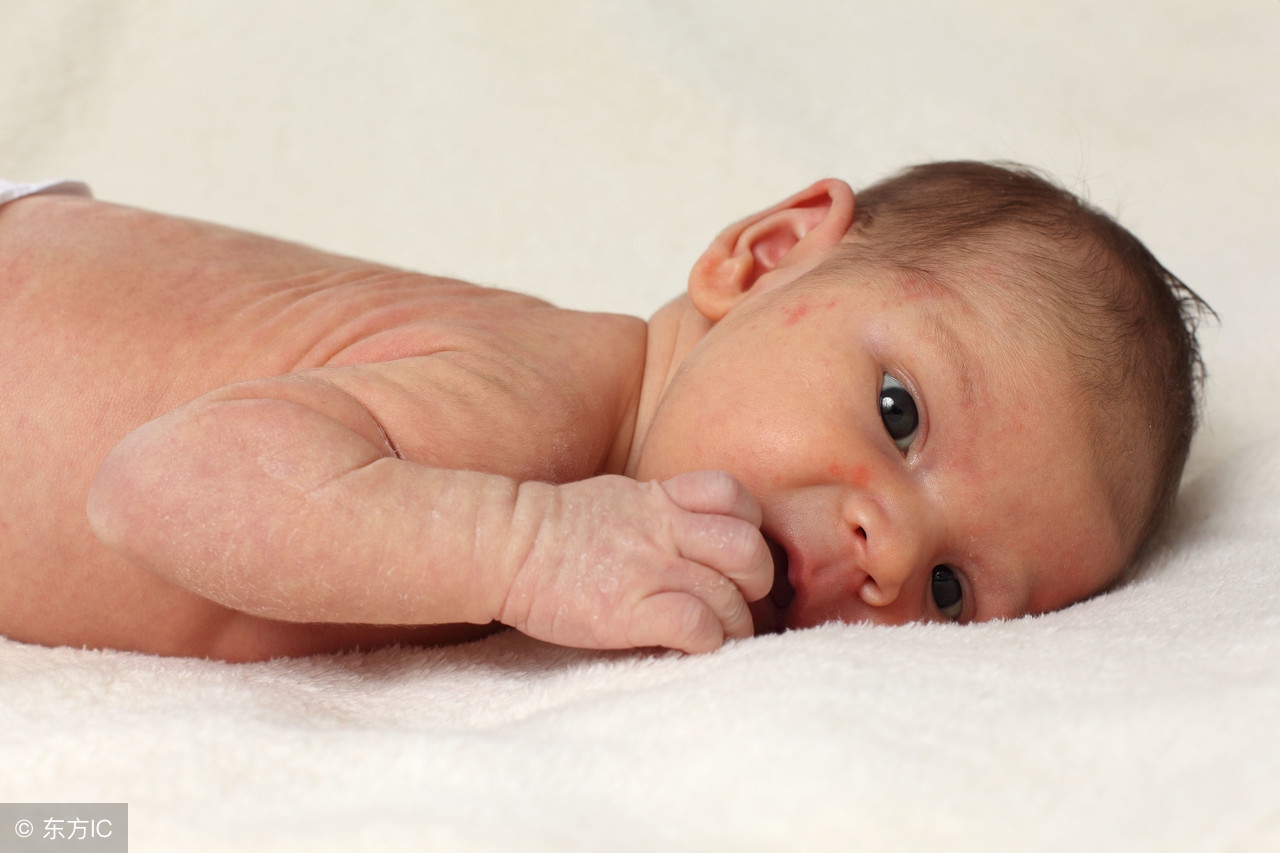 夏季湿疹怎么治疗有特效药吗,夏季湿疹反复发作瘙痒