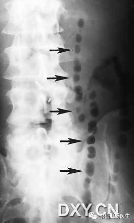 10种经典肠道影像征象：绳征、串珠征、螺纹征……你听过几个？