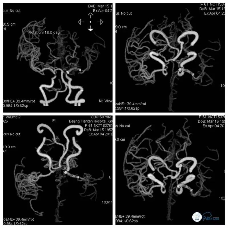 大脑中动脉支架术后再狭窄的几率,天坛医院介入脑血管手术