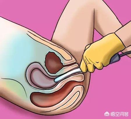 阴道超声报告卵巢多囊性改变，是怎么回事？需要治疗吗？