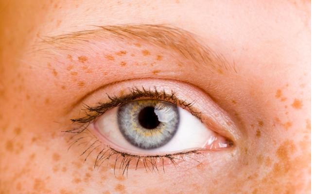 脸上长了褐斑是什么原因,脸上起褐斑怎么治疗最好