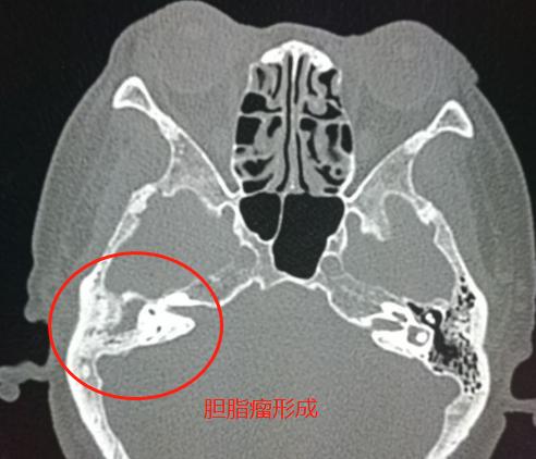 孩子听力下降的最佳恢复方法,鼻窦炎引起中耳炎听力下降怎么治