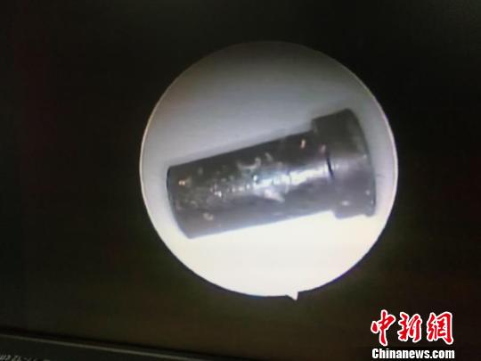 广州男孩把玩具塞进耳朵专家：若异物入耳勿自行掏取