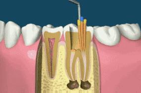 新生儿牙龈上的白脓包,牙龈炎症脓包疼痛怎么办
