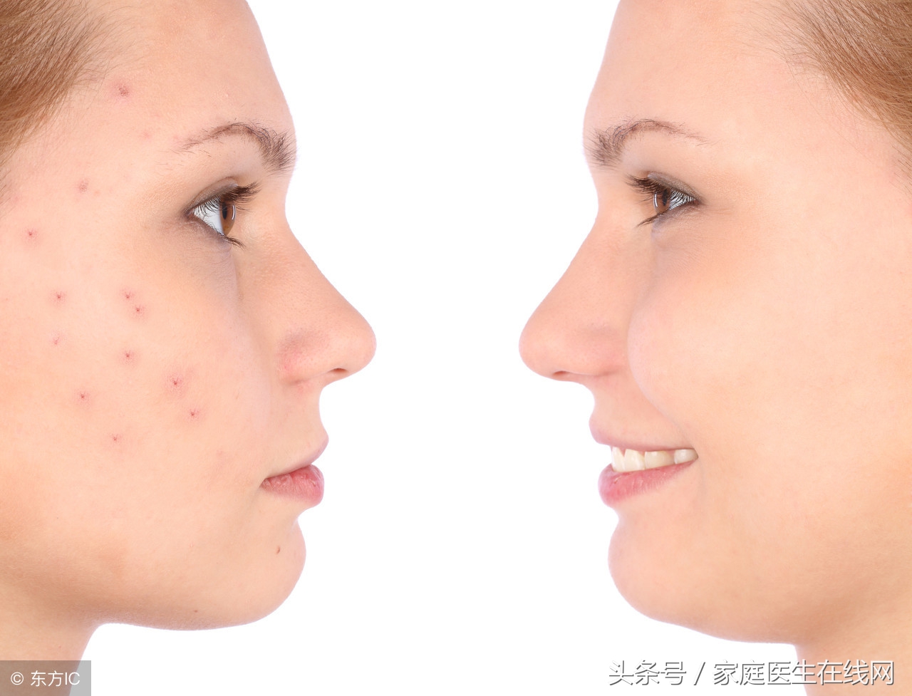 为什么有些人脸上长很多痘痘,为什么有的人脸部很容易长痘痘