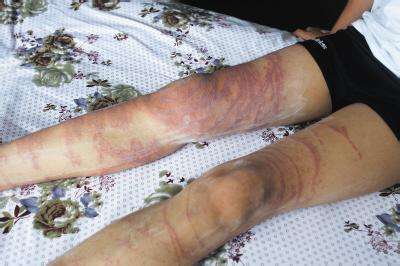 海蜇蜇伤后印记如何消除,海蜇蜇人用尿液管用吗