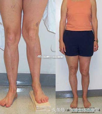 矫正长短腿去哪里矫正,体态矫正腿