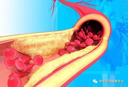 高血压停药的危害,高血压带来的危害有哪些