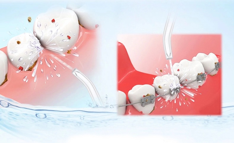 冲牙器改善牙龈出血,超声波冲牙器清洁牙垢是否有效果