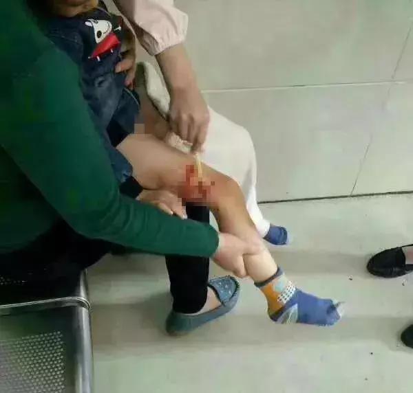 被狗咬住不放要学会这样自救救人,被狗咬住不松了怎么办