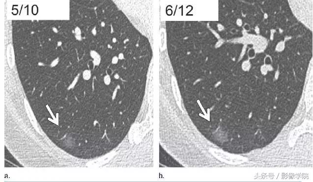 肺结节14种影像,一百例有结果的肺结节影像分析