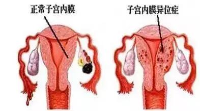 20岁子宫腺肌症能根治吗,子宫腺肌症能彻底根治吗