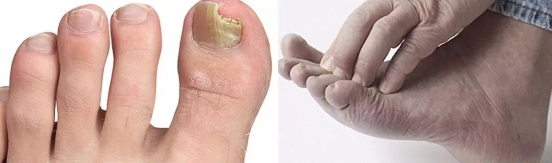 脚气清脚气专用乳膏,比较管用的脚气膏