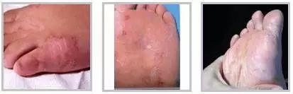 怎么才可以拯救汗脚,如何拯救脚臭