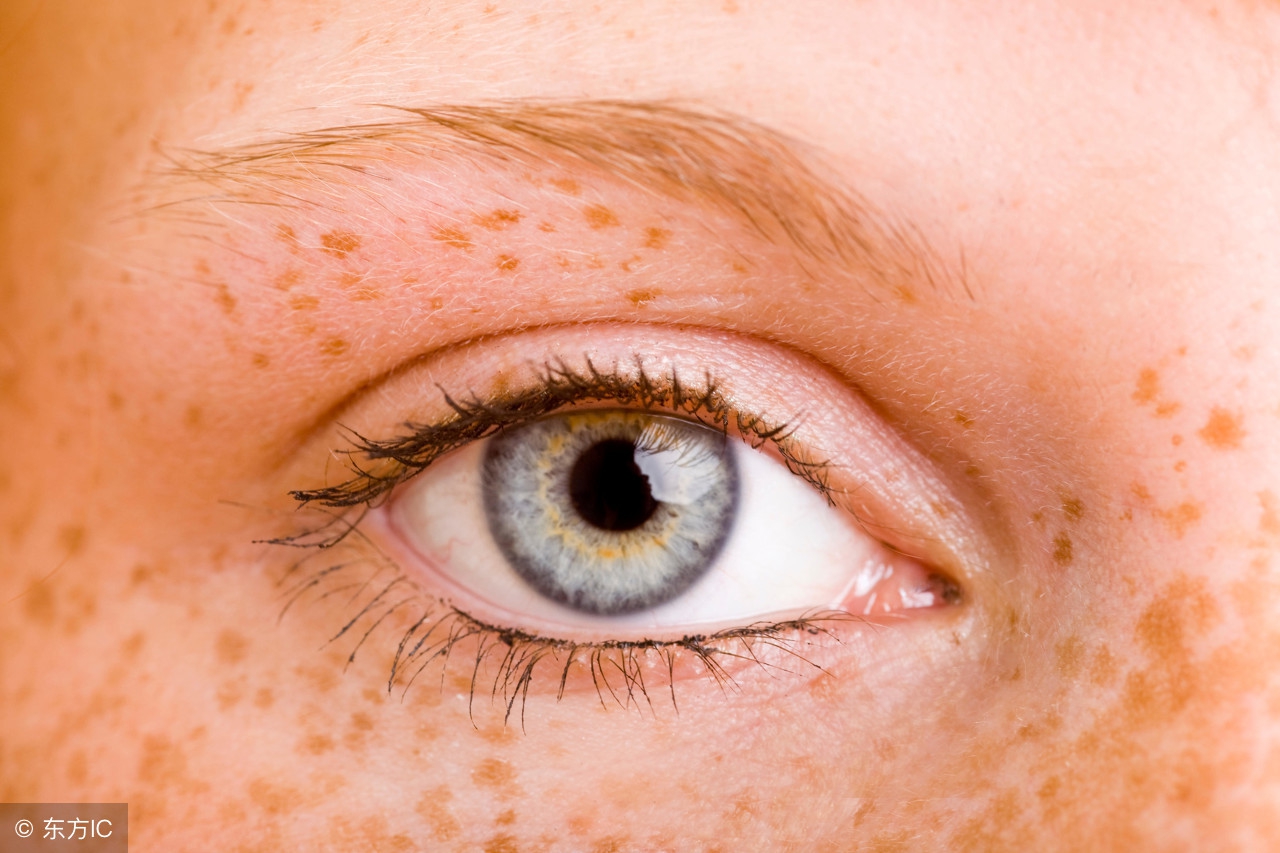 祛斑各种斑的专业知识,号称斑中之王的黄褐斑之祛斑攻略