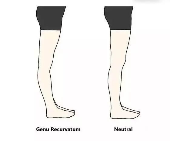 膝超伸导致的小腿粗如何解决,小腿超粗是什么原因