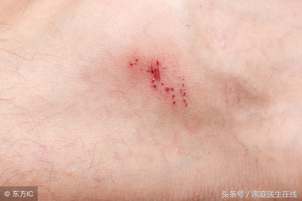 擦伤伤口的正确处理方法,小伤口需要注意什么