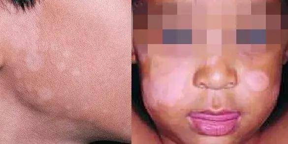 宝宝脸上长了白斑,是不是肚子里有蛔虫?