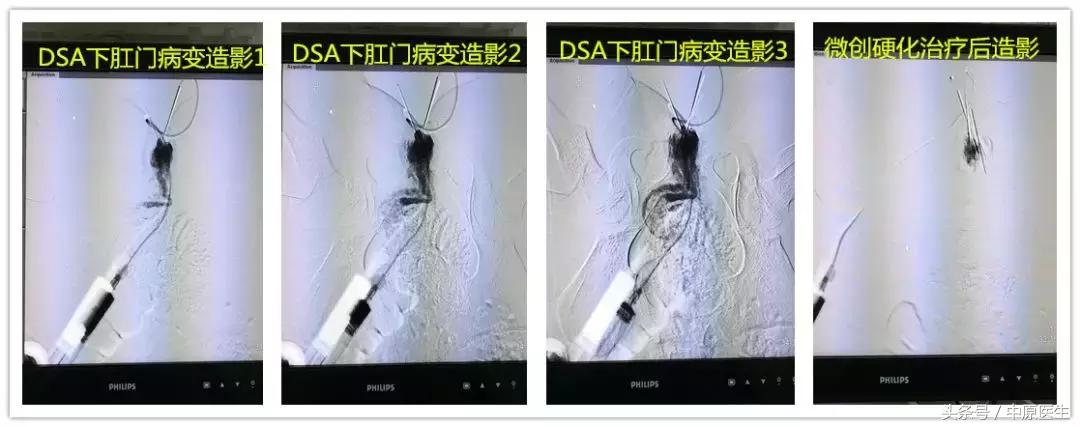 6岁孩子有痔疮是什么情况,8岁的孩子痔疮很严重怎么办