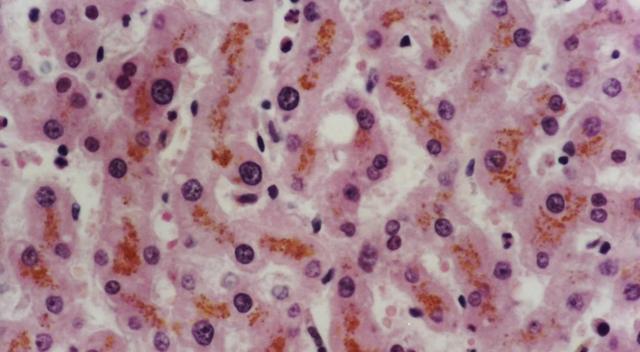 老年斑的最佳消除方法,老年斑不容易去除的原因