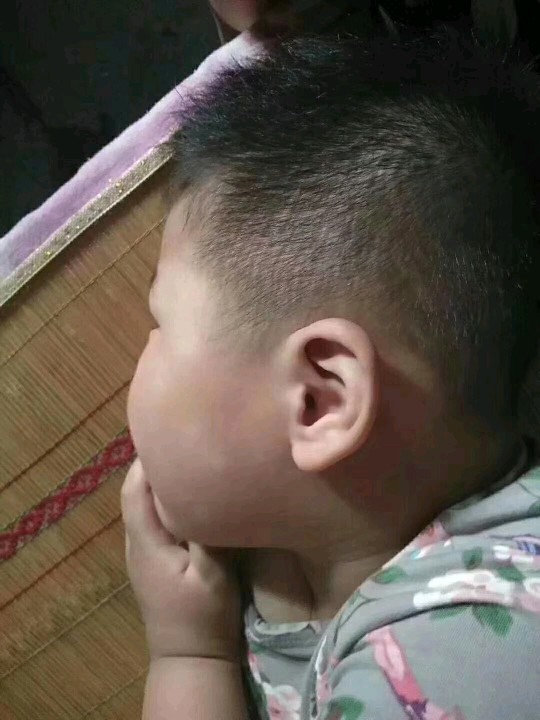 宝宝积食出现积食斑,宝宝积食会长疹子吗