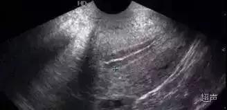 卵泡11mm子宫内膜厚度8mm,子宫内膜厚度和卵泡大小有关系吗